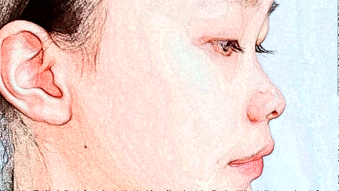 鼻翼缩小价格表_鼻翼缩小术后还会反弹吗