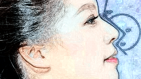 鼻翼缩小价格表_鼻翼缩小术后还会反弹吗