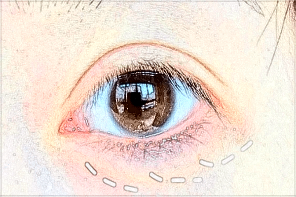 2024上睑提肌的价格表(10月更新)_上睑提肌后遗症