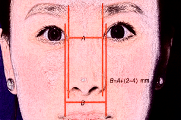 上海伯思立隆鼻哪个医生好?附2024收费价格表