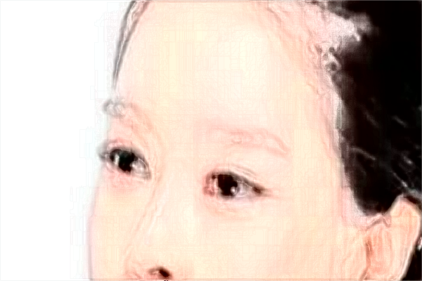 2024割双眼皮价目表公布_割双眼皮大概多久能恢复正常