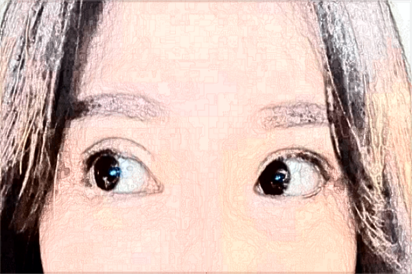 割双眼皮几天拆线佳?割双眼皮几天可以热敷?