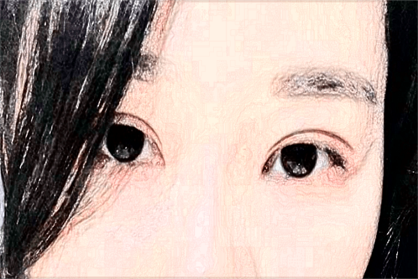 割双眼皮打麻药疼吗?割双眼皮打麻药打哪里?