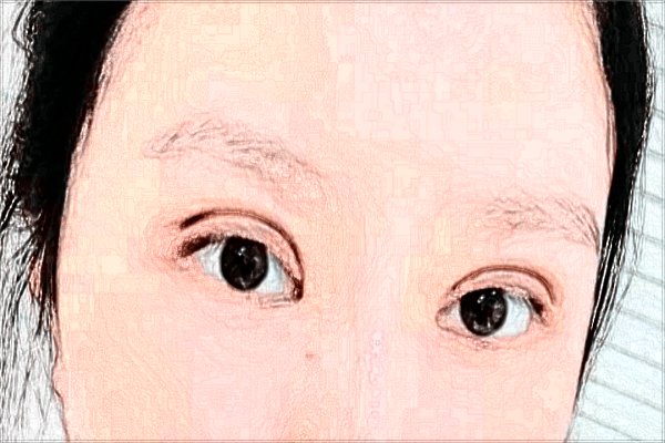 割双眼皮打麻药疼吗?割双眼皮打麻药打哪里?