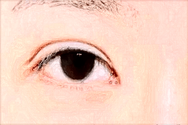 2024北京同仁医院做双眼皮价格表(价目表)怎么样