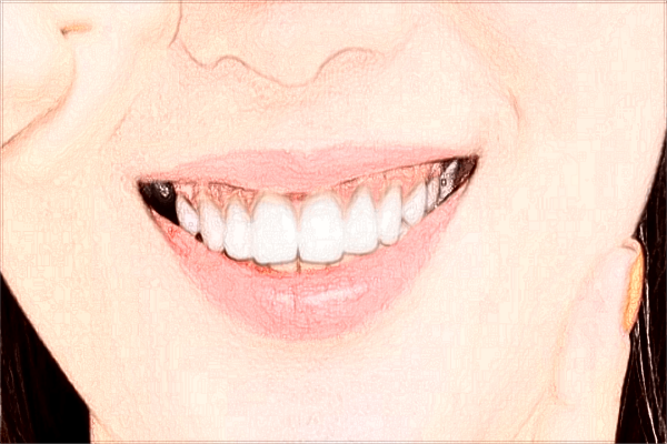 2024义乌牙齿矫正价目表_牙齿矫正的步骤和流程