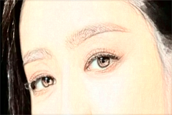 厦门做眼角提升怎么样?厦门眼角提升价格表公布