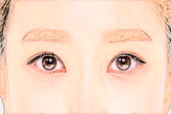 上海时光整形医院做提眉怎么样_提眉术和全切双眼皮哪个效果好