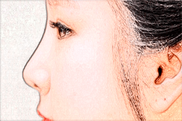 2024四川省中医院激光祛痘收费价格怎么样