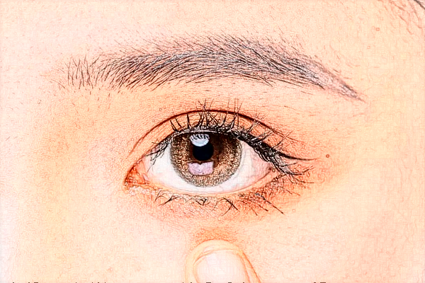 2024上海伊莱美去眼袋做的好吗【附去眼袋案例】