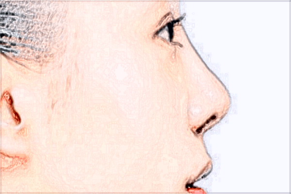 广州海峡鼻修复怎么样?2024鼻修复价格表一览