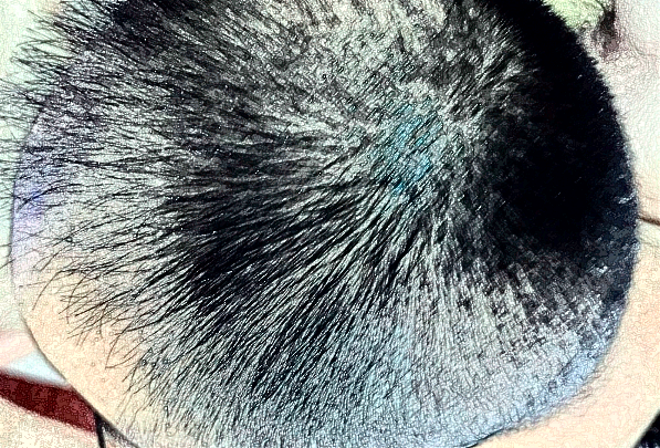 北京丽都植发怎么样_医生名单