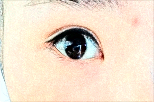 北京丽都开眼角哪个医生好【开眼角案例】