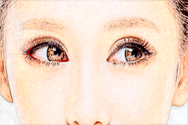 北京丽都开眼角哪个医生好【开眼角案例】