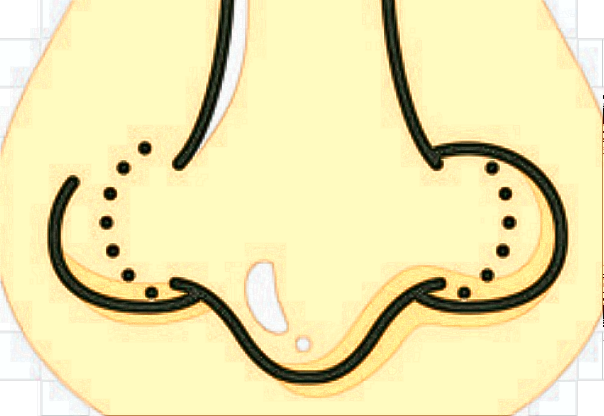 膨体隆鼻有什么后遗症?膨体隆鼻有风险吗?