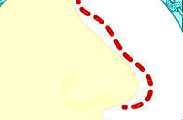 膨体隆鼻多少费用?膨体隆鼻要忌口多长时间?