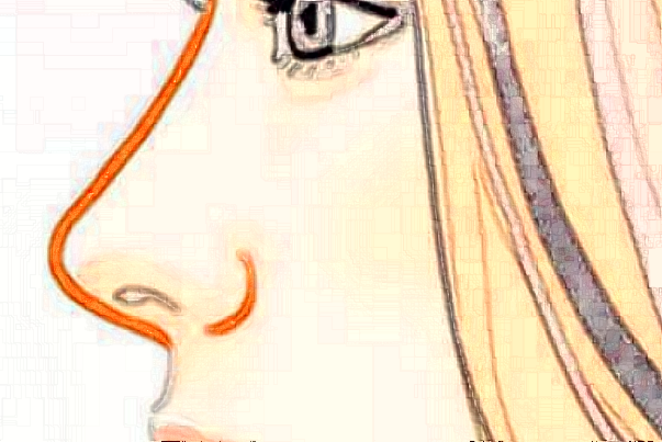 膨体隆鼻需要拆线吗?膨体隆鼻需要几天恢复?