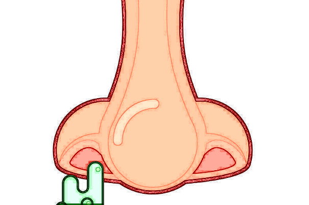 膨体隆鼻需要耳软骨吗?膨体隆鼻需要开刀吗?