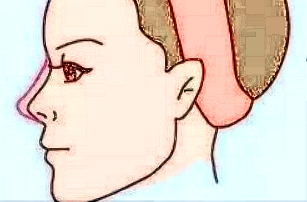 膨体隆鼻需要麻醉吗?膨体隆鼻需要全麻吗?