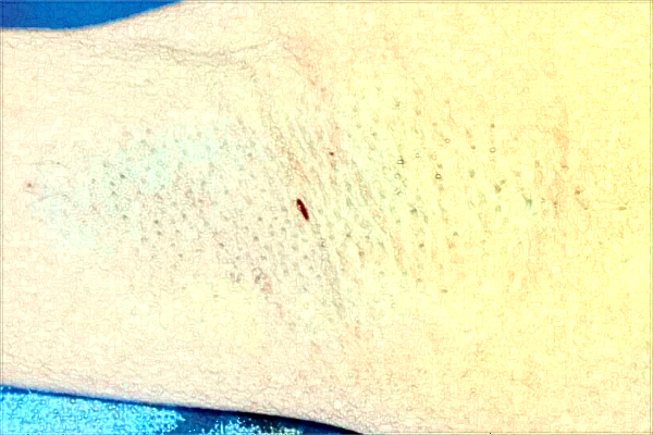 南京市中医院激光狐臭做的好吗？需要多少钱