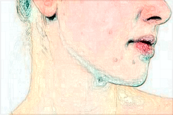 赣南医学院第一附属医院光子嫩肤多少钱2024?光子嫩肤好吗