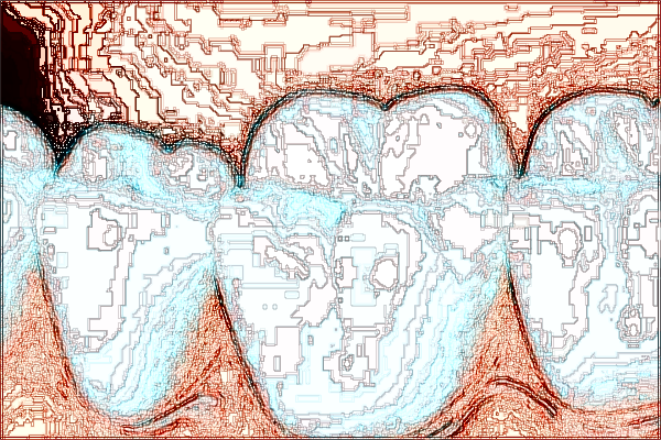 河北省口腔医院隐形矫正价格表_做的怎么样