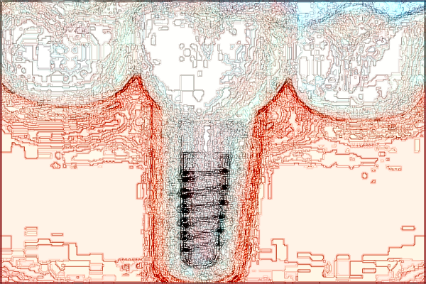 北大口腔医院隐形口腔正畸价格表_案例