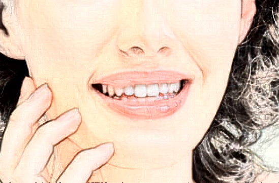 北京大学第一医院热拉提做的好吗【热拉提案例】