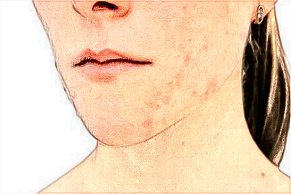 河科大二附院去痣哪个大夫好?祛痣整形价格2024