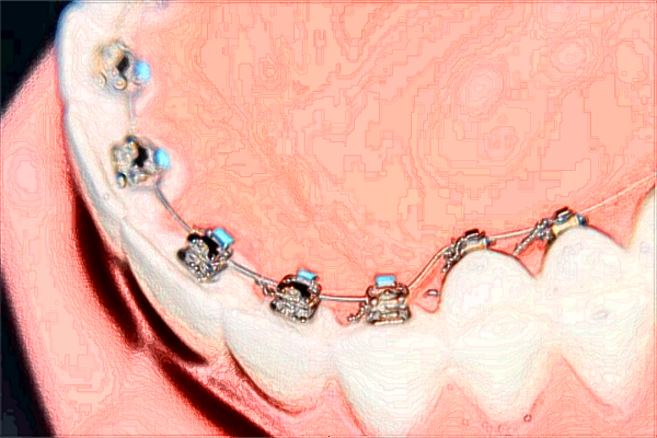 北大口腔医院镶满口牙多少钱_镶满口牙需要把牙都拔掉吗