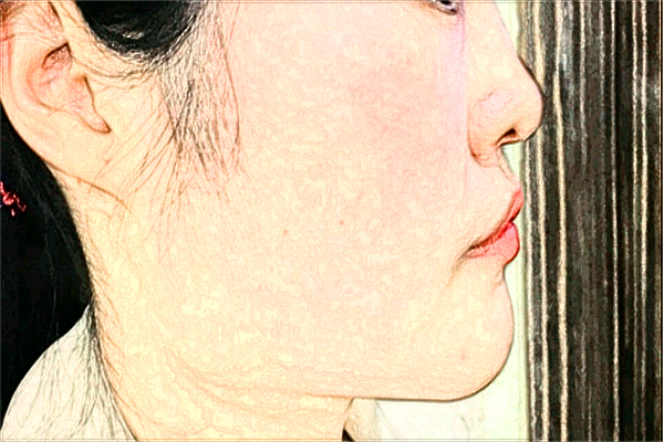 成都华西医院祛斑价目表_祛斑后的注意事项有哪些