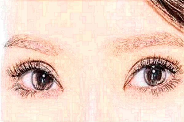 2024广州华美去眼袋手术一般多少钱【去眼袋案例】