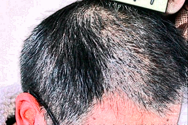 广州华美植发靠谱吗_怎么样