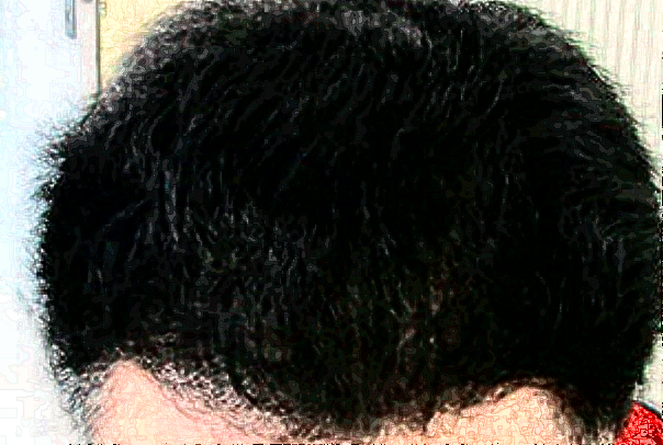 广州华美植发靠谱吗_怎么样