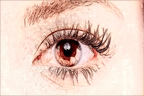 2024无锡市第二人民医院去眼袋做的怎么样_案例+价格