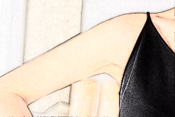 河北省人民医院激光脱毛做的好吗【激光脱毛案例分享】