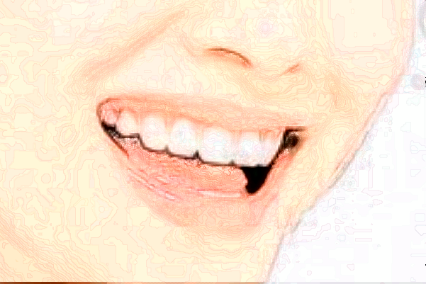 宁波市第一医院牙齿美容做的好吗【牙齿美容案例】