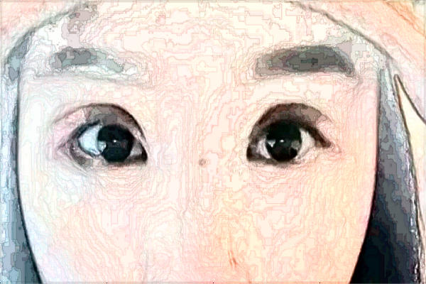 浙江省中医院填泪沟做的好不好_填泪沟多长时间恢复好