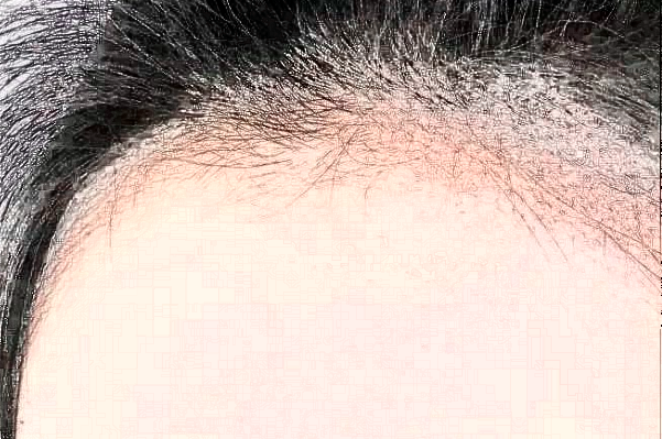 2024常州市第一人民医院植发价目表(价格表)怎么样