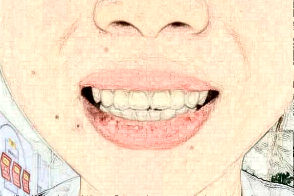 常州市第一人民医院拔智齿需要多少钱_案例分享