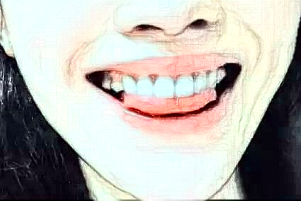 常州市第一人民医院拔智齿需要多少钱_案例分享