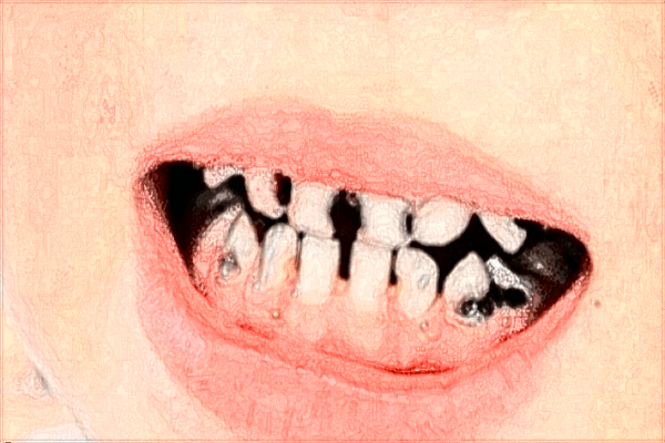 江西省口腔医院种植牙哪个医生好?2024种植牙医生收费