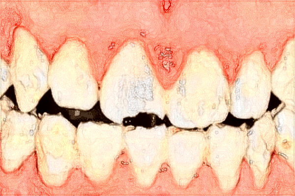 江西省口腔医院补牙怎么样?江西省口腔医院补牙材料