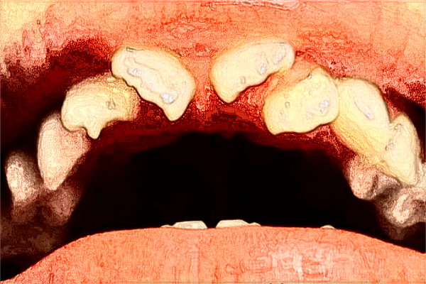 2024江西省口腔医院补牙贵吗?补牙后一般能维持几年