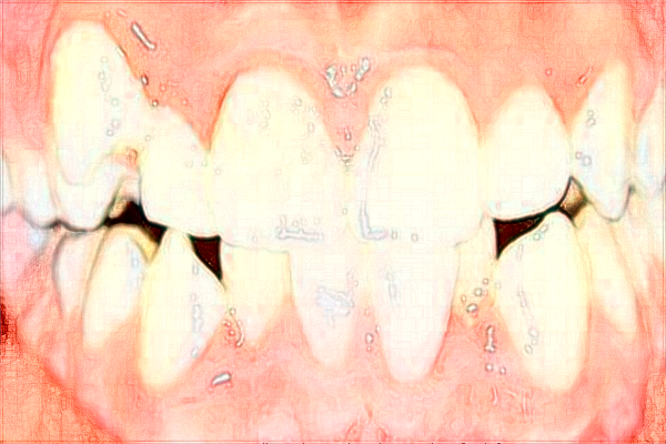 中山大学附属第一医院隐适美好吗?2024隐适美价格多少