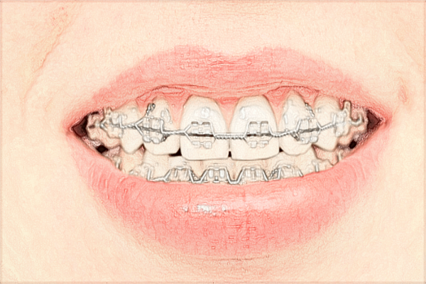 2024珠海市人民医院矫正牙齿多少钱?矫正牙齿好吗