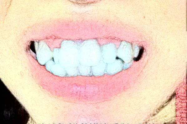 2024天津市口腔医院烤瓷牙多少钱_哪个医生比较好