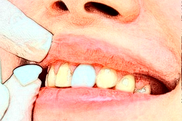 天津市口腔医院牙齿贴面做的怎么样【案例反馈】