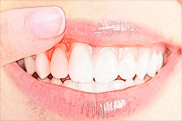 2024山东省千佛山医院牙齿矫正多少钱?牙齿矫正年龄范围