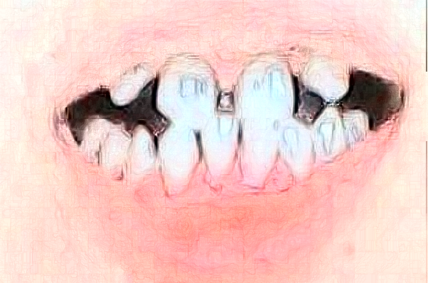 常州市第三人民医院口腔科牙齿不齐矫正多少钱_真实案例分享